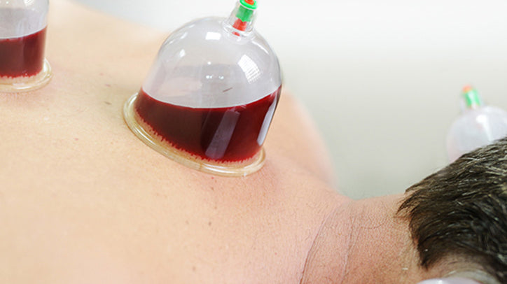 About Hijama
